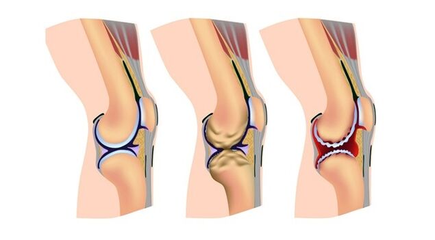 stopnje artroze kolenskega sklepa