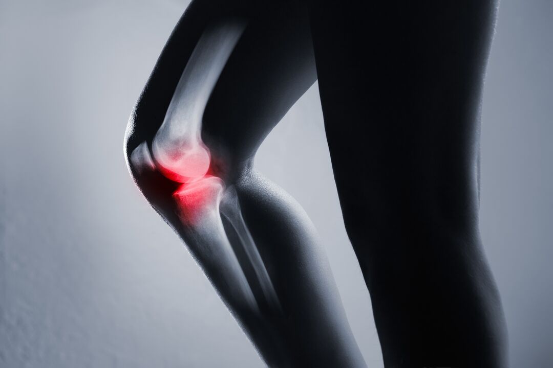 vnetje kolenskega sklepa z artrozo