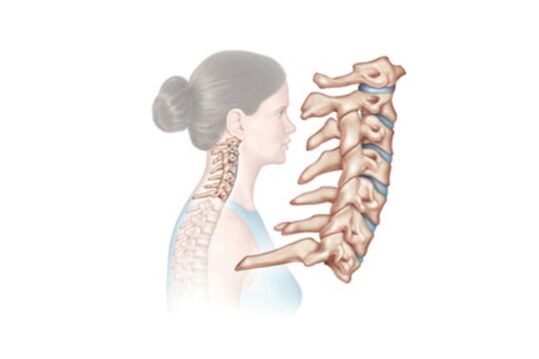 poškodbe vratne hrbtenice z osteohondrozo