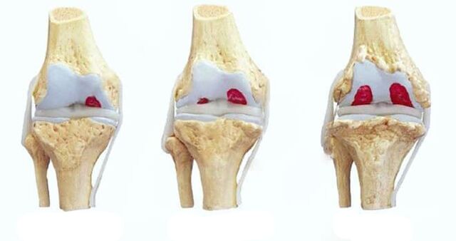 faze osteoartritisa kolena