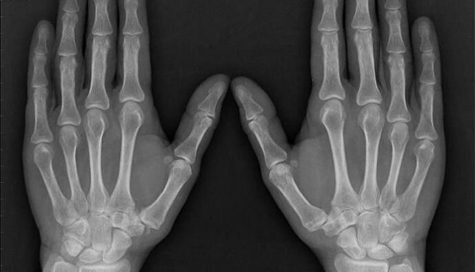 rentgensko slikanje za diagnozo artritisa in artroze