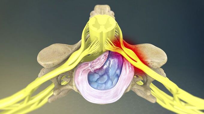 Eden od vzrokov za bolečine v hrbtu je hernija diska. 