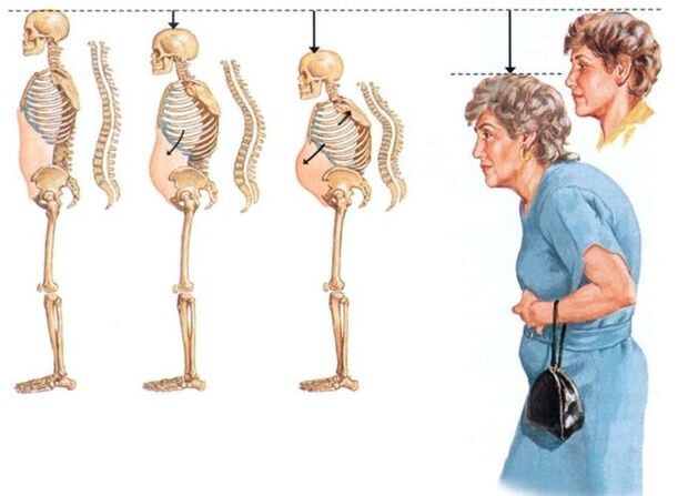 stopnje cervikalne osteohondroze