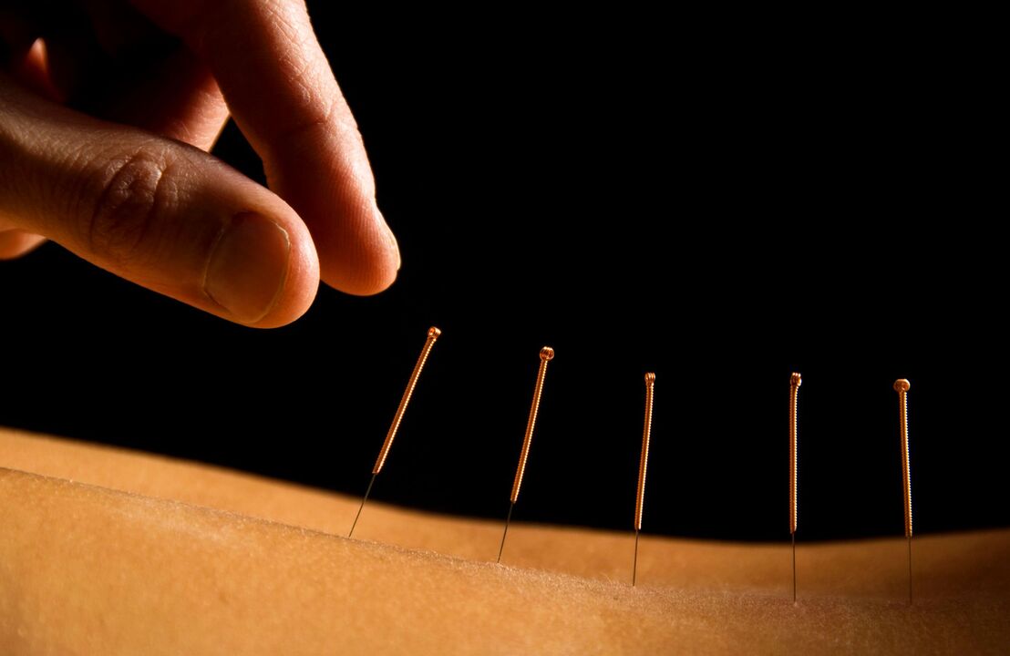 akupunktura za bolečine v hrbtu