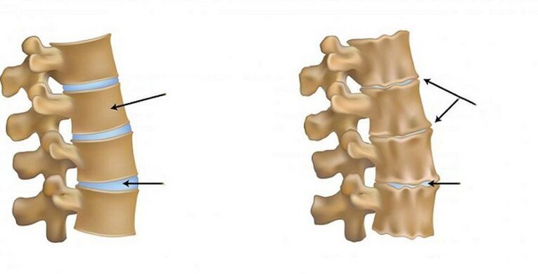 Ishemični sindrom za osteohondrozo