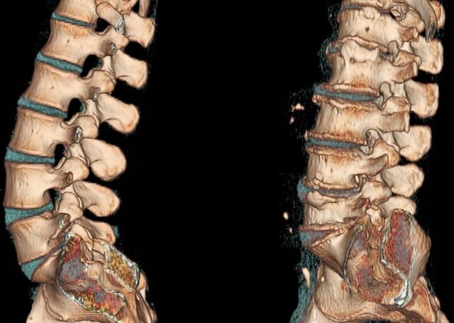 Osteohondroza ledvenega območja