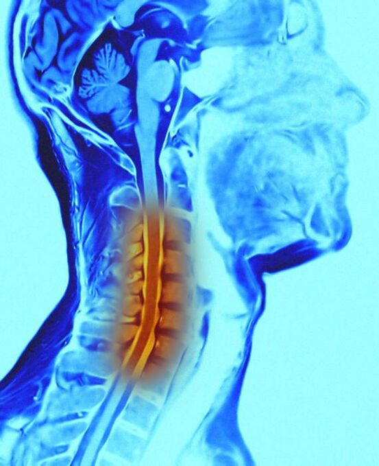 vratne hrbtenice in osteohondroze